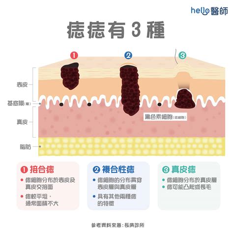 身體很多痣|痣變大、痣多或長毛會變皮膚癌？認識痣的形成與原因